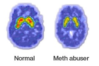 a normal brain’s synapses compared to that of a meth user a normal brain's synapses compared to that of a meth user