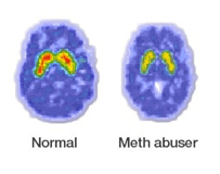 a normal brain's synapses compared to that of a meth user